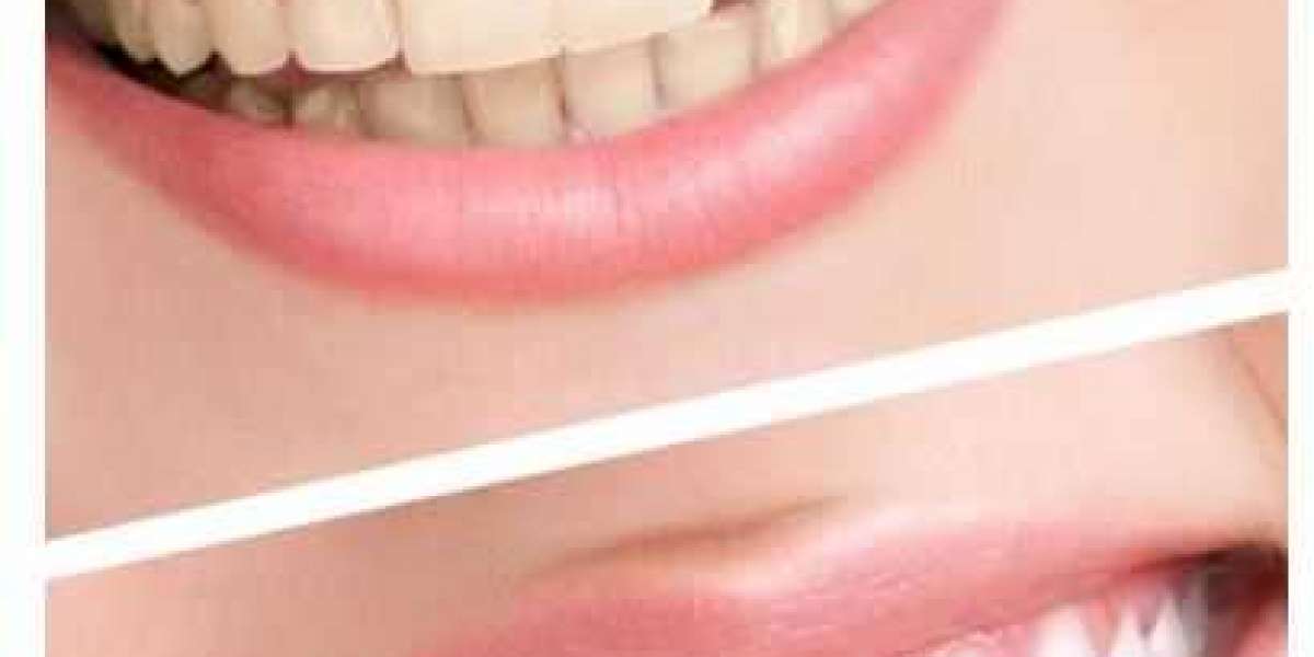 Teeth whitening in Plano