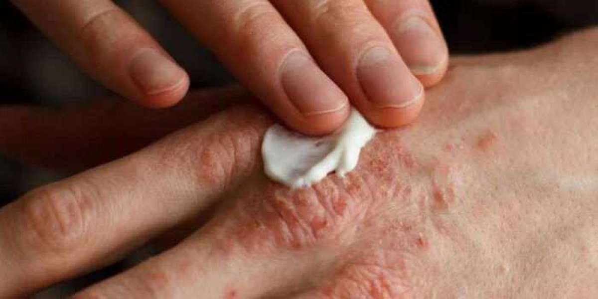 Experience the Best Ayurvedic Treatment for Psoriasis in Surat